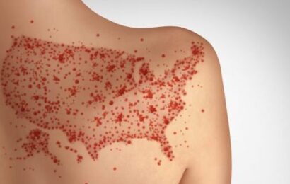 Pennsylvania reports fourth Measles death as outbreak nears 700 cases amid feud with Trump administration
