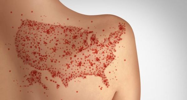Pennsylvania reports fourth Measles death as outbreak nears 700 cases amid feud with Trump administration