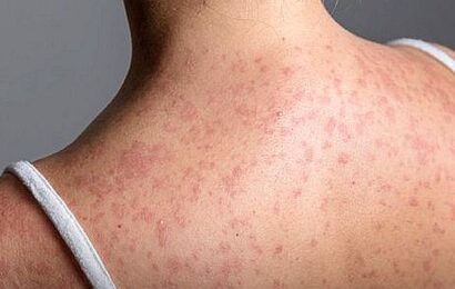 Pennsylvania woman dies from measles complications as 2026 outbreak surges