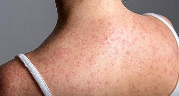Pennsylvania woman dies from measles complications as 2026 outbreak surges