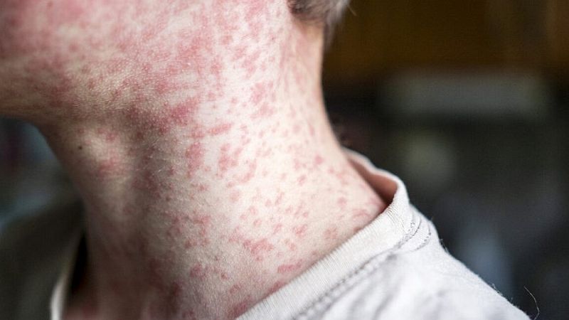 ews Today: Pennsylvania reports fourth Measles death as outbreak nears 700 cases amid feud with Trump administration. Image credit: X
